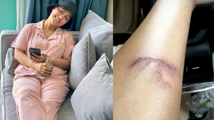 Hina Khan Injures Leg During Vacation; Shares Painful Update