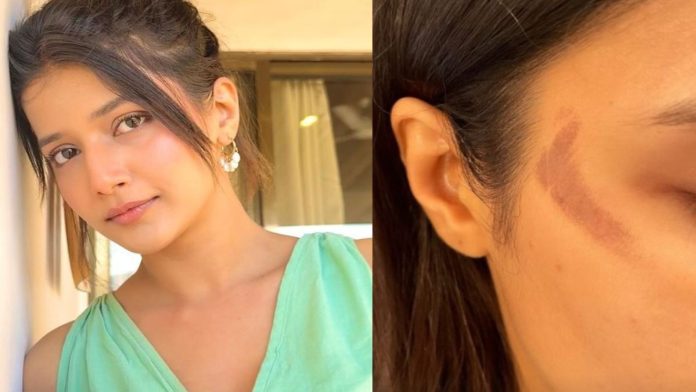 YRKKH's Samridhii Shukla Reveals Shocking Burn Injuries & Marks